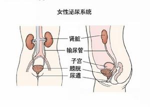 複雜性尿路感染