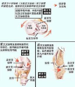 前十字韌帶損傷