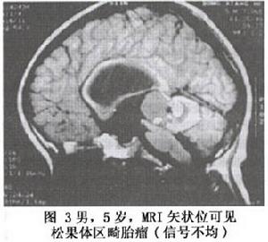 兒童松果體區腫瘤