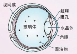 飛蠅症