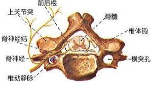 極外側型腰椎間盤突出症