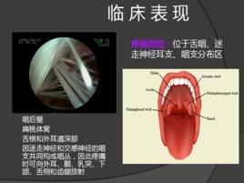 舌咽神經痛神經根切斷術