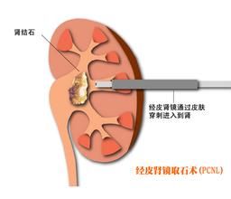 經皮腎鏡取石術