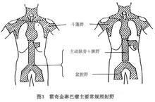 老年人霍奇金淋巴瘤