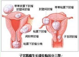 多發子宮肌瘤