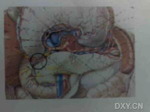 胰腺假性囊腫