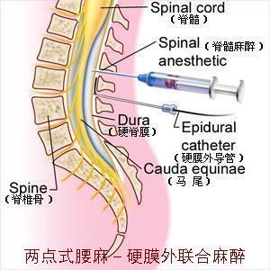 腰麻示意圖