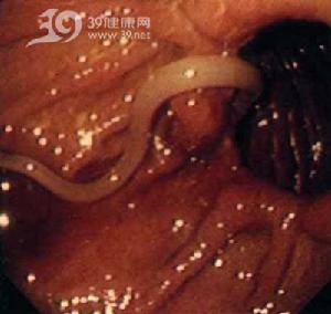 蛔蟲性急性胰腺炎