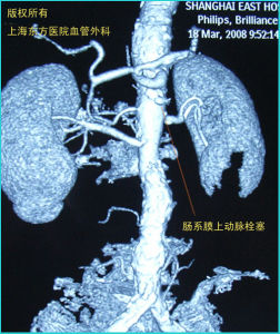 腸系膜上動脈栓塞