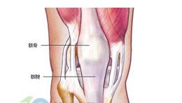 髕腱斷裂