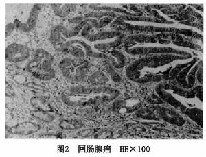 （圖）小腸腺癌