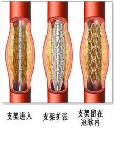 心臟支架