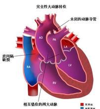 完全性肺靜脈異位引流