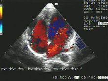 彩色都卜勒超聲心動圖