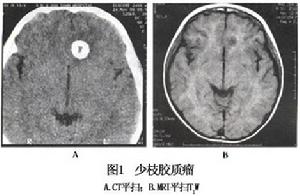 少枝膠質細胞瘤及間變少枝膠質細胞瘤