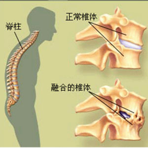 強直性脊柱炎