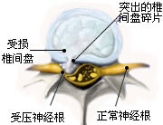 腰椎間盤突出圖