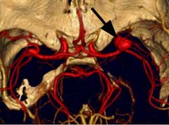 顱內動脈瘤