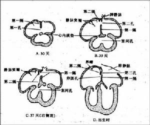 老年甲減性心臟病