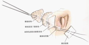 CRM時空梭除皺提升術