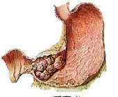 （圖）胃反應性淋巴增生