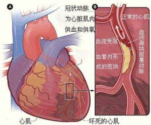 心肌梗塞並發二尖瓣關閉不全