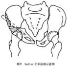 先天性髖關節脫位及髖發育不全