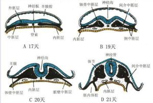 神經管畸形