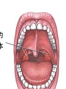 扁桃腺炎