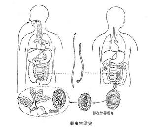 蛔蚴移行症