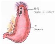 示意圖14:將胃底縫攏