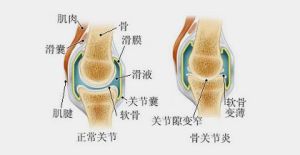 勞損性關節炎