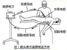 高頻電刀