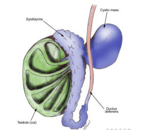 附睪囊腫