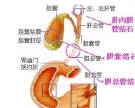 膽道結石