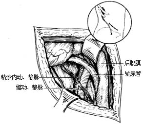 圖2:顯露中段輸尿管(示意圖)