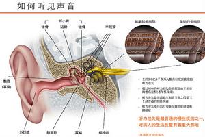 （圖）感音性耳聾