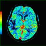 頭顱及胸腹部CT灌注影像