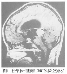 松果體細胞瘤