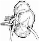 腎盂造瘺術