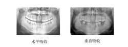 牙槽骨吸收