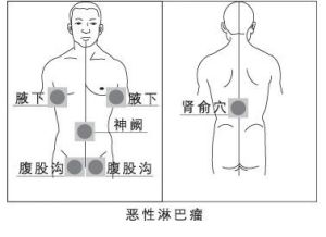 惡性淋巴瘤