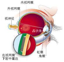 人工視力