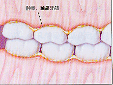 牙齦腫痛