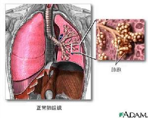 急性侵襲型肺麴黴病