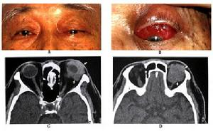 眼眶非霍奇金惡性淋巴瘤