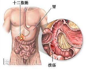 上消化道出血