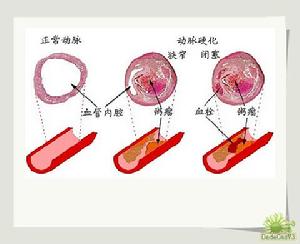 妊娠糖尿病