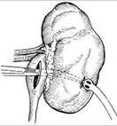 腎盂造瘺術