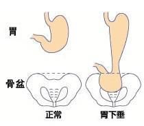 肝鬱脾虛型胃下垂